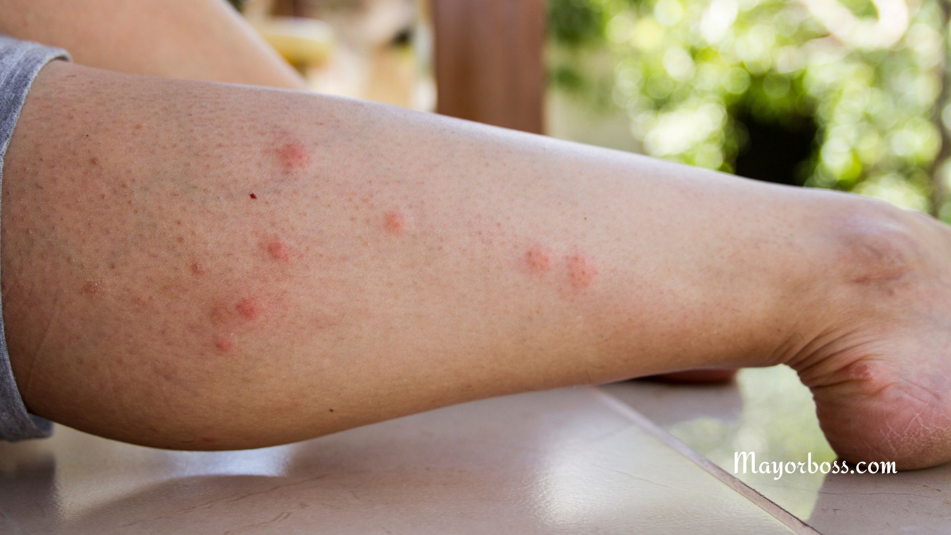 How to Prevent and Treat Chigger Bites