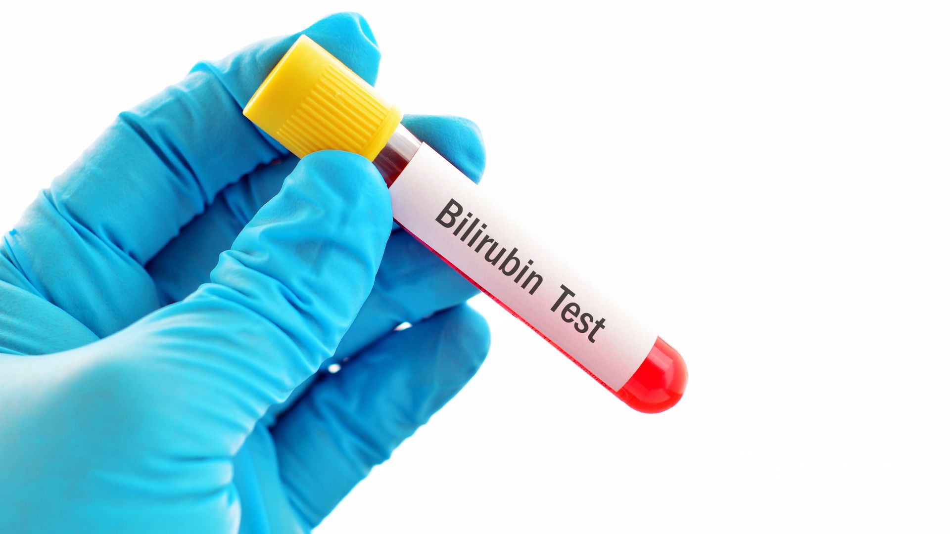 Low Bilirubin Levels