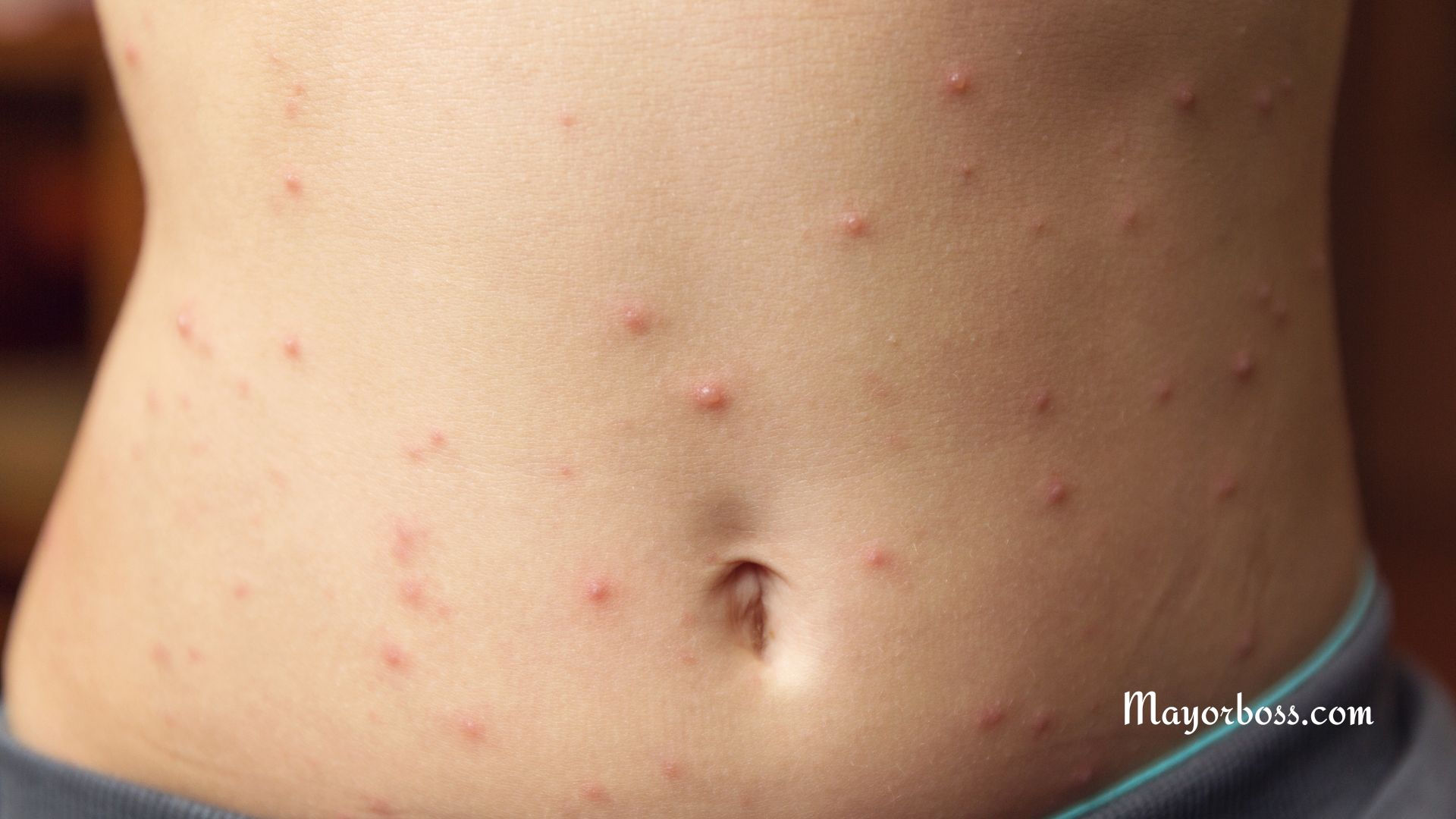 Pimples on Stomach