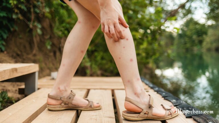 Sand Flea Bites