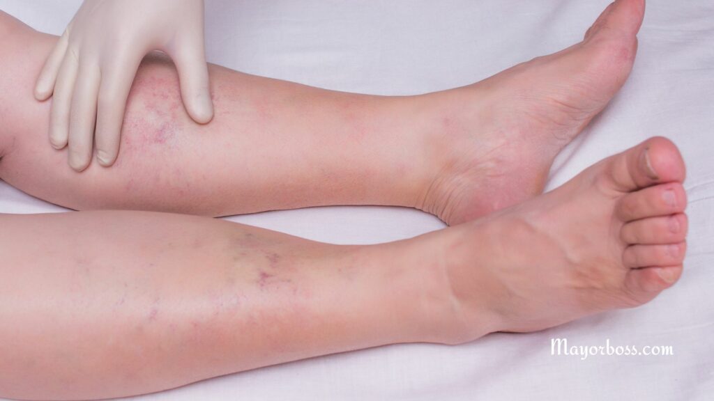 Symptoms of Varicose Veins