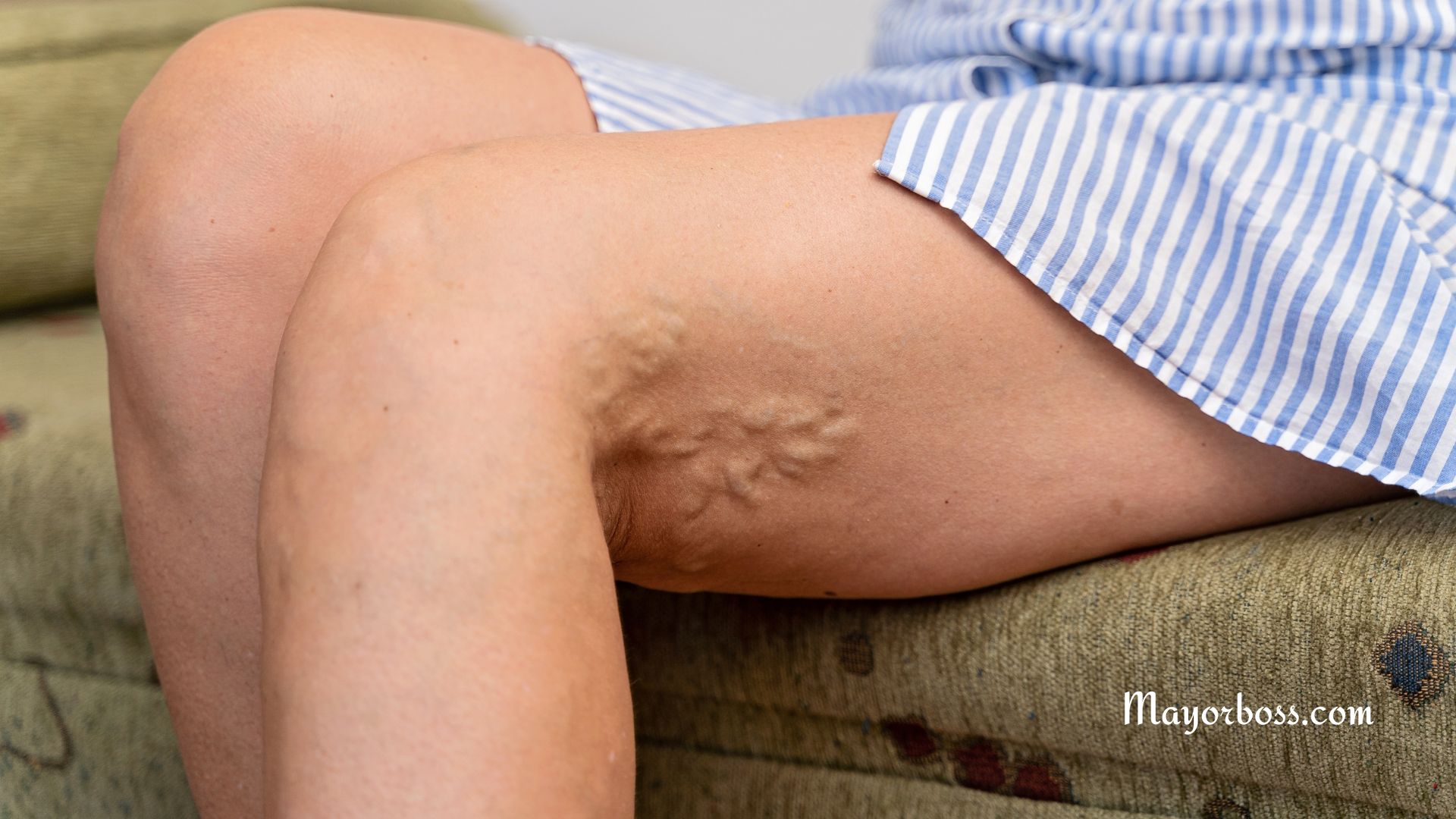 What Can I Do For Varicose Veins?