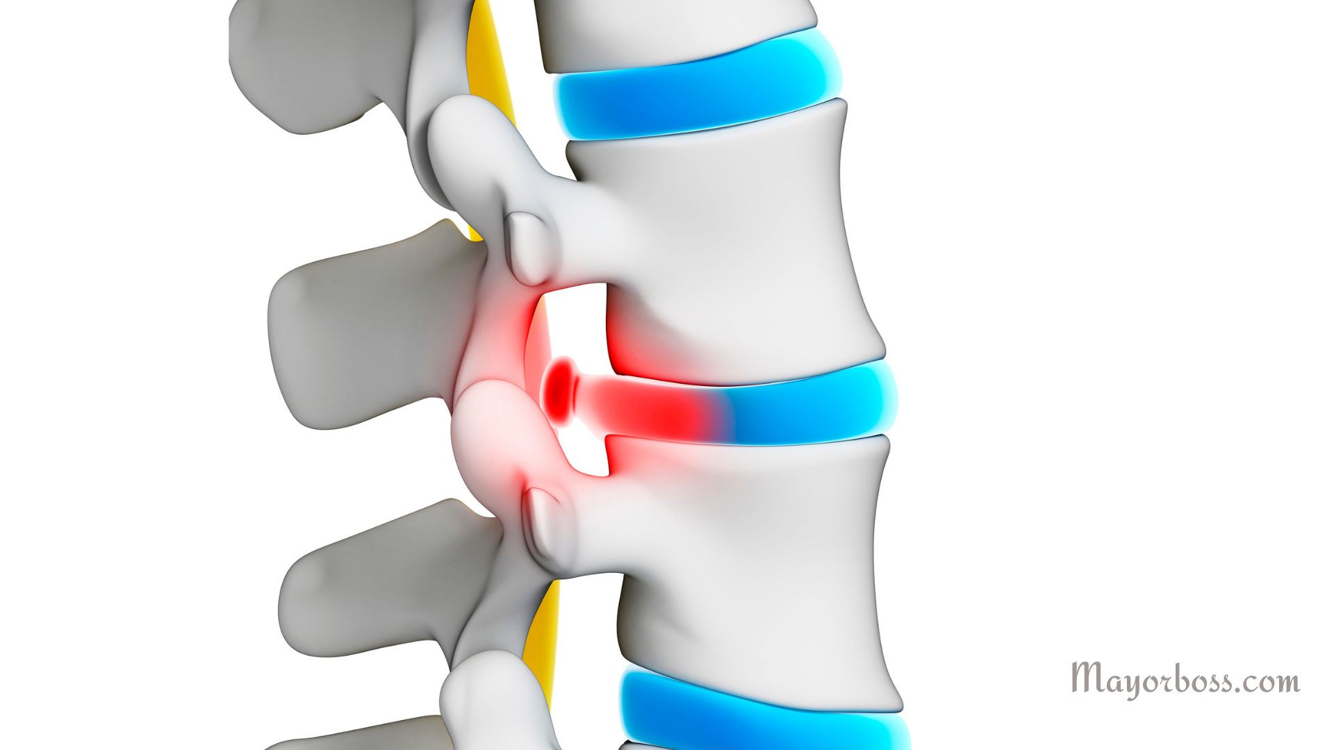 What Is A Bulging Disc?