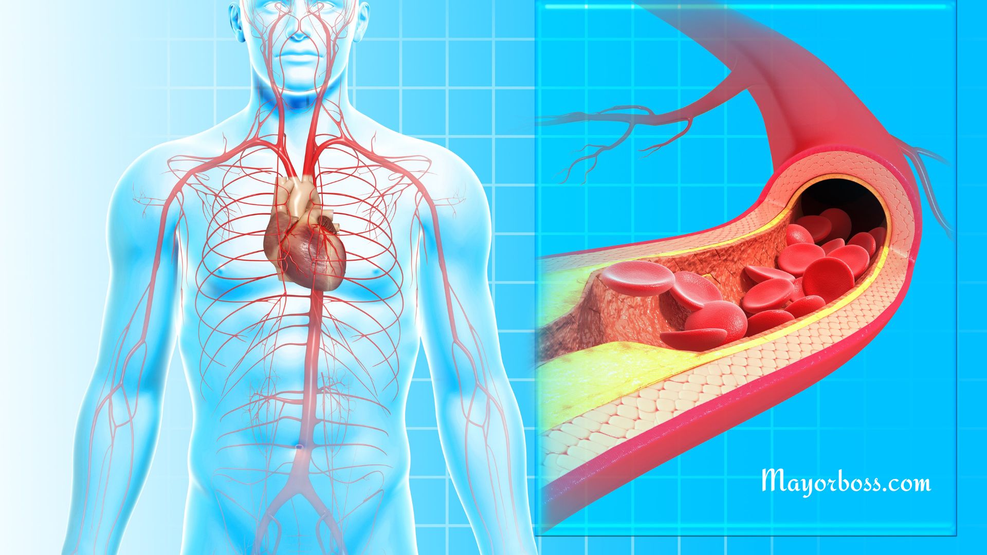 What Is Atherosclerosis?