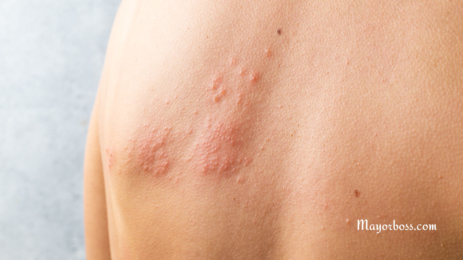 What Is Shingles?