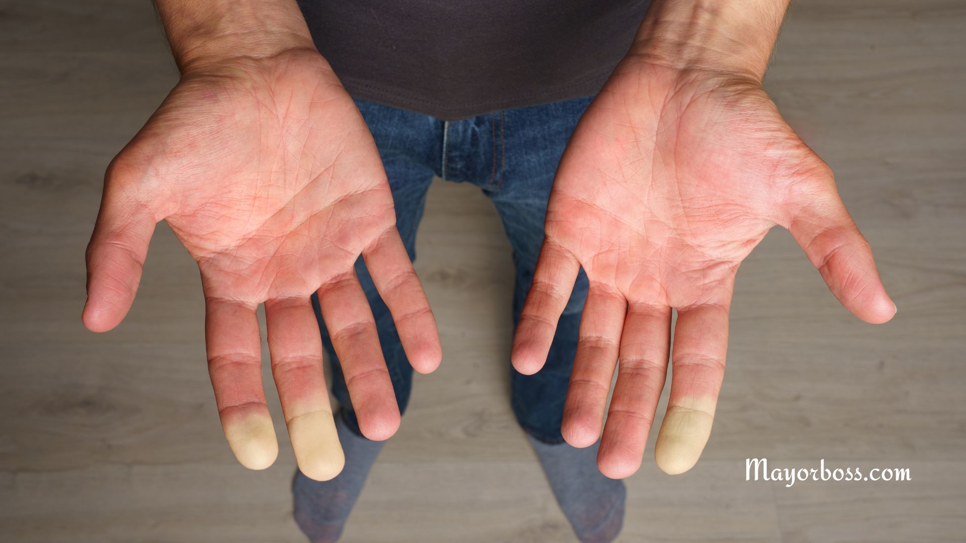 What is Raynaud's Syndrome?