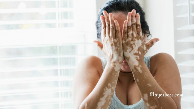 What is Vitiligo?