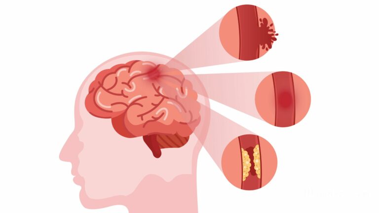 _What is a Hemorrhagic Stroke