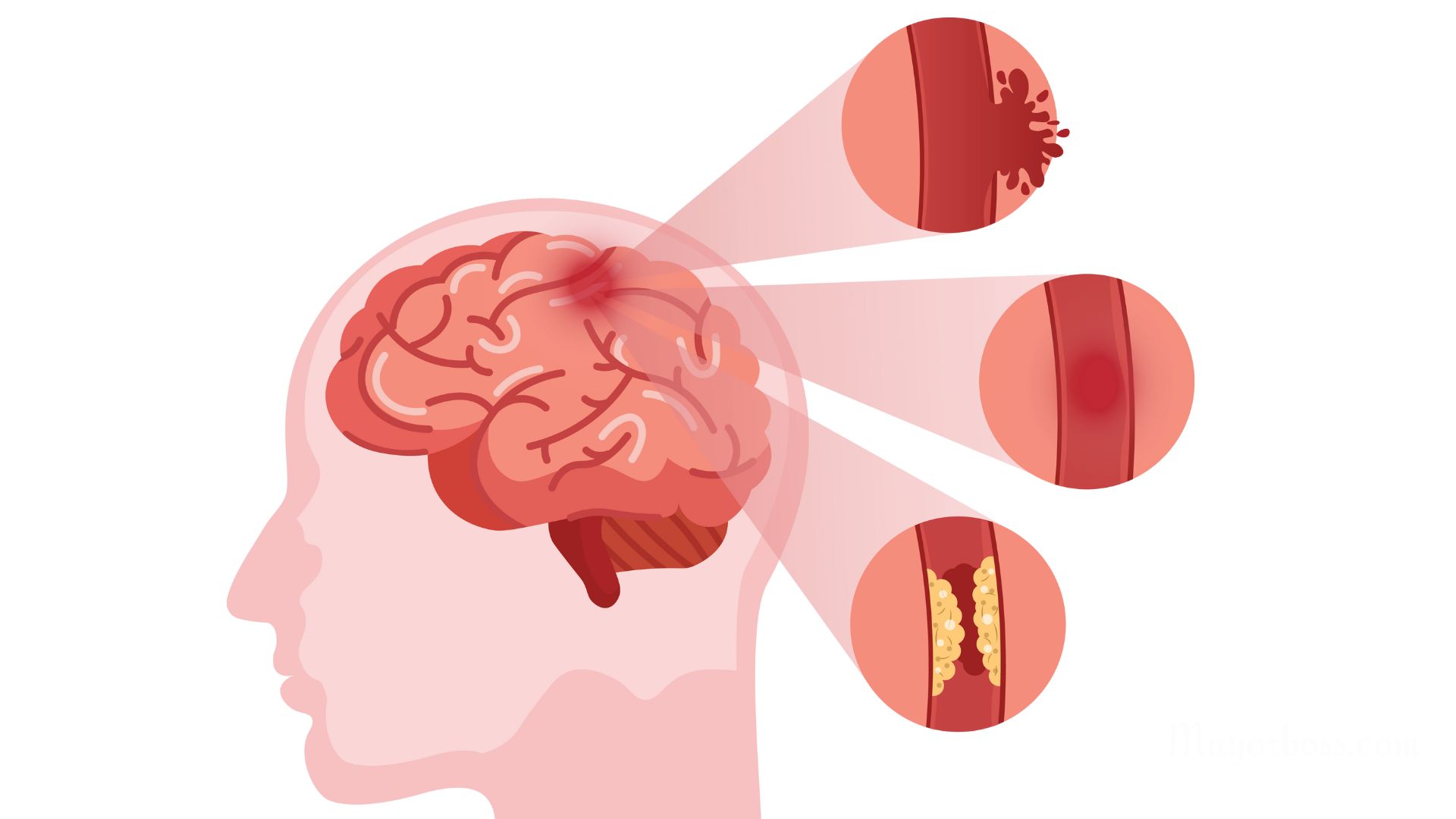 What is a Hemorrhagic Stroke?