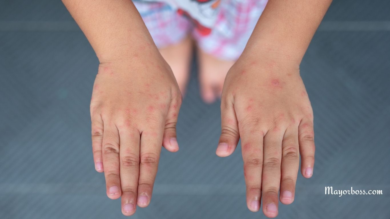 Symptoms of Meningitis: Early Warning Signs You Should Never Ignore