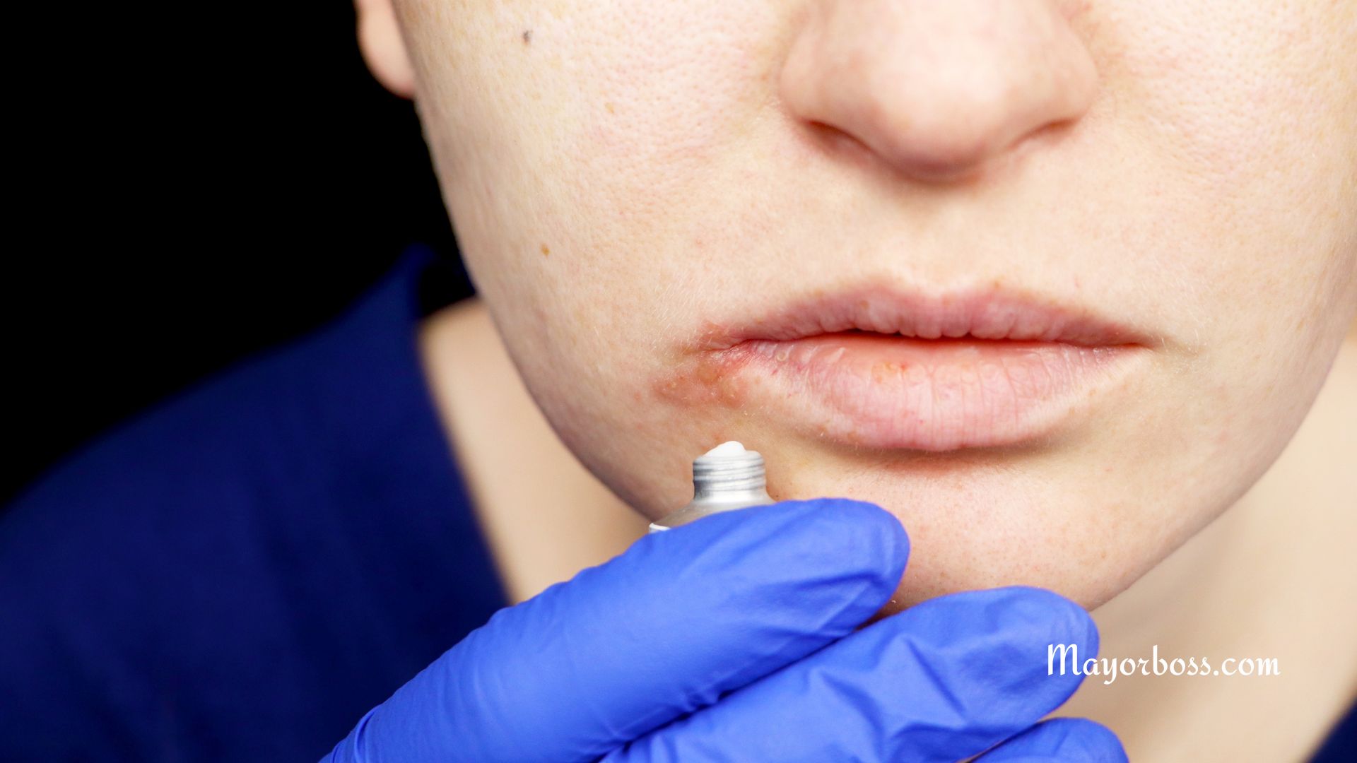 to Get Rid of Cold Sores Fast