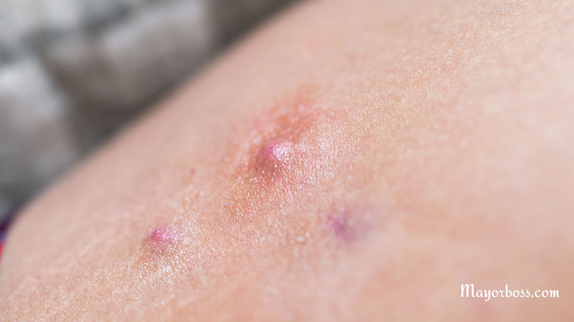 Boil On Inner Thigh