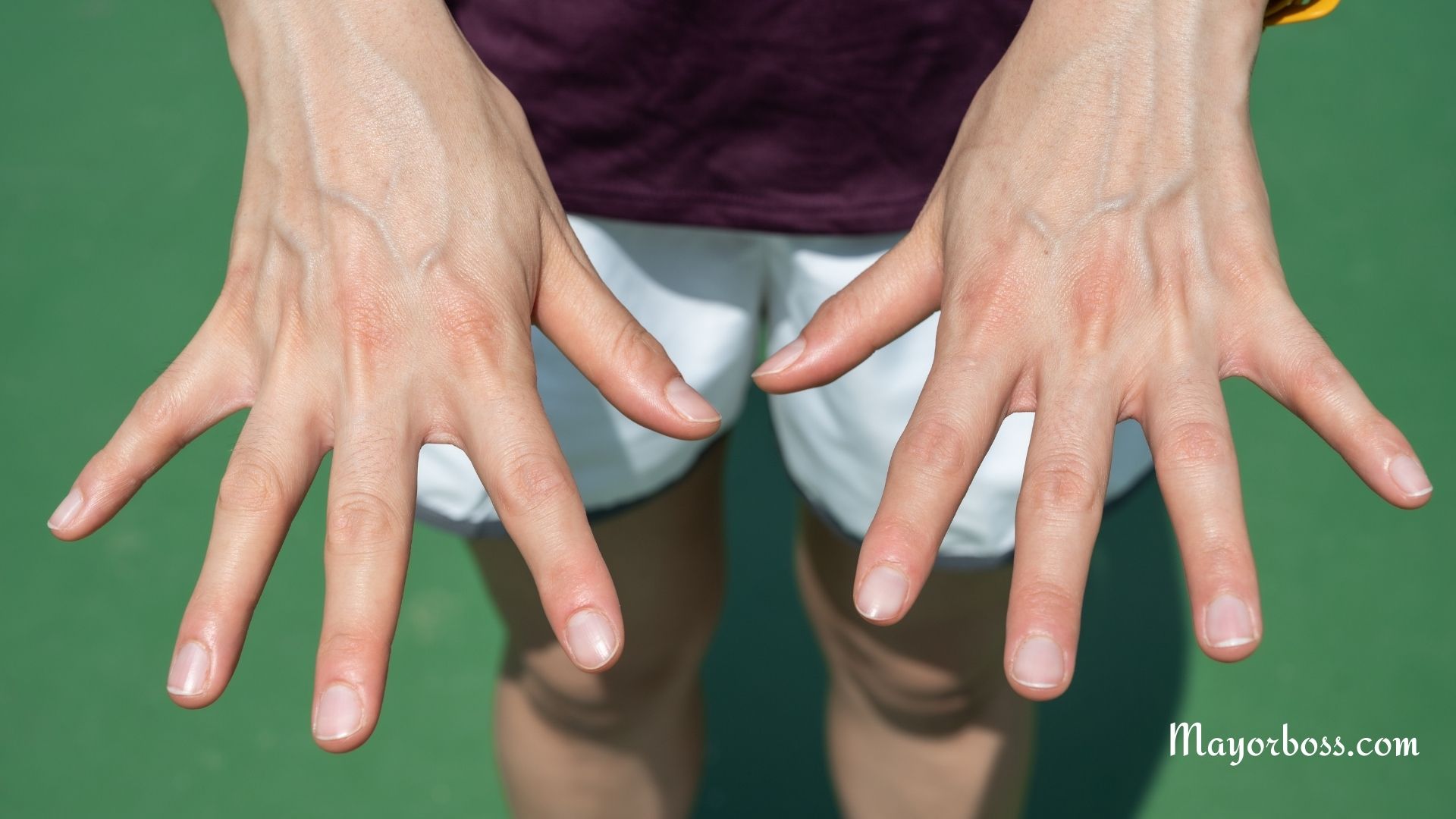 Bulging Hand Veins: What You Need to Know