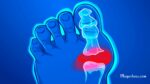 How To Remove Uric Acid Crystallization From Your Body To Prevent Gout And Joint Pain