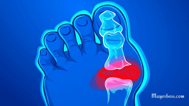 How To Remove Uric Acid Crystallization From Your Body To Prevent Gout And Joint Pain
