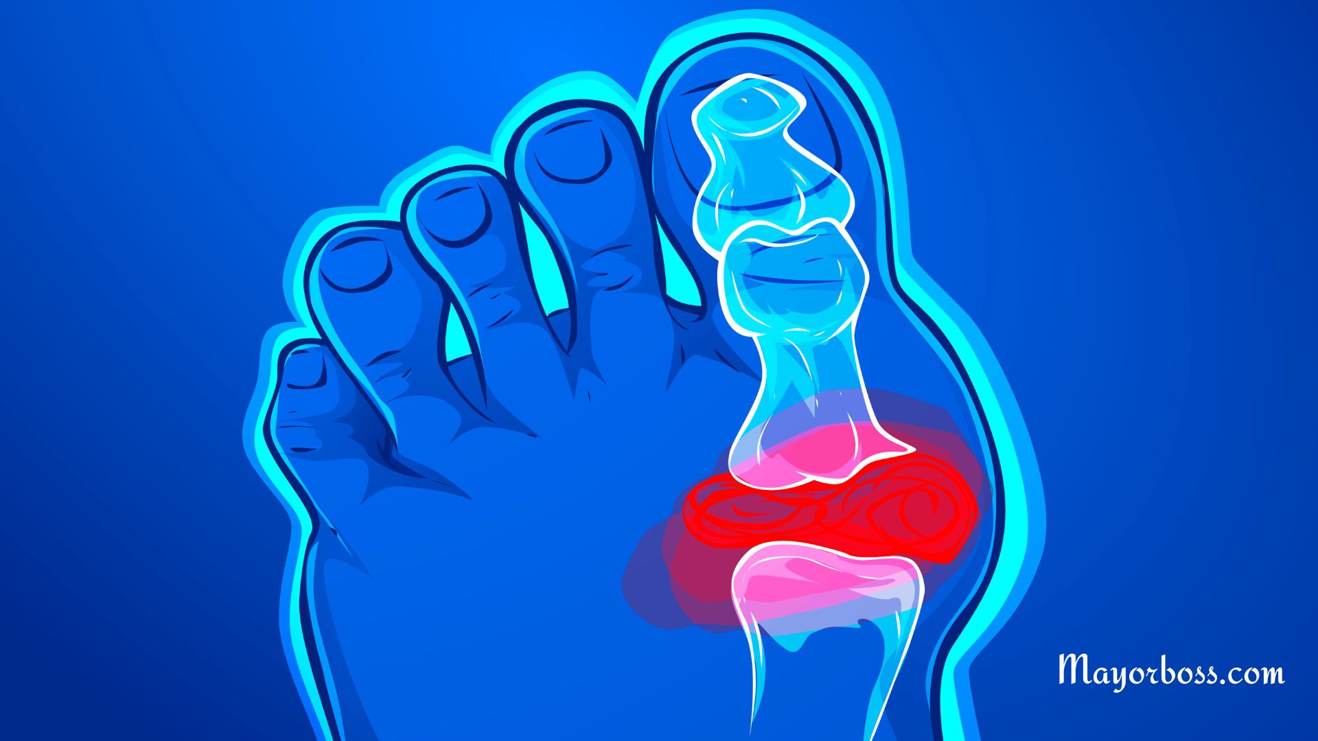 How To Remove Uric Acid Crystallization From Your Body To Prevent Gout And Joint Pain