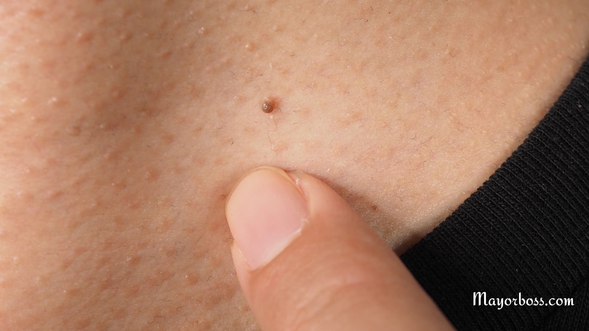 How to Identify and Treat Non-STD Warts