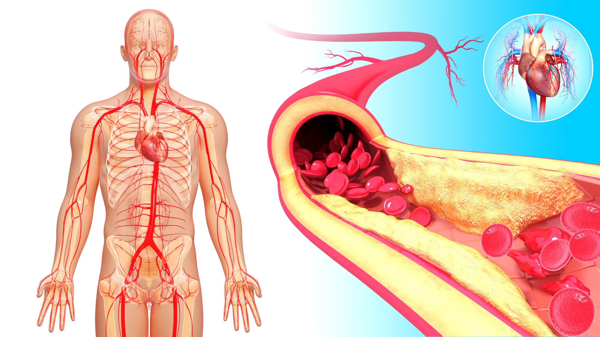 6 Signs That Your Arteries Are Clogged