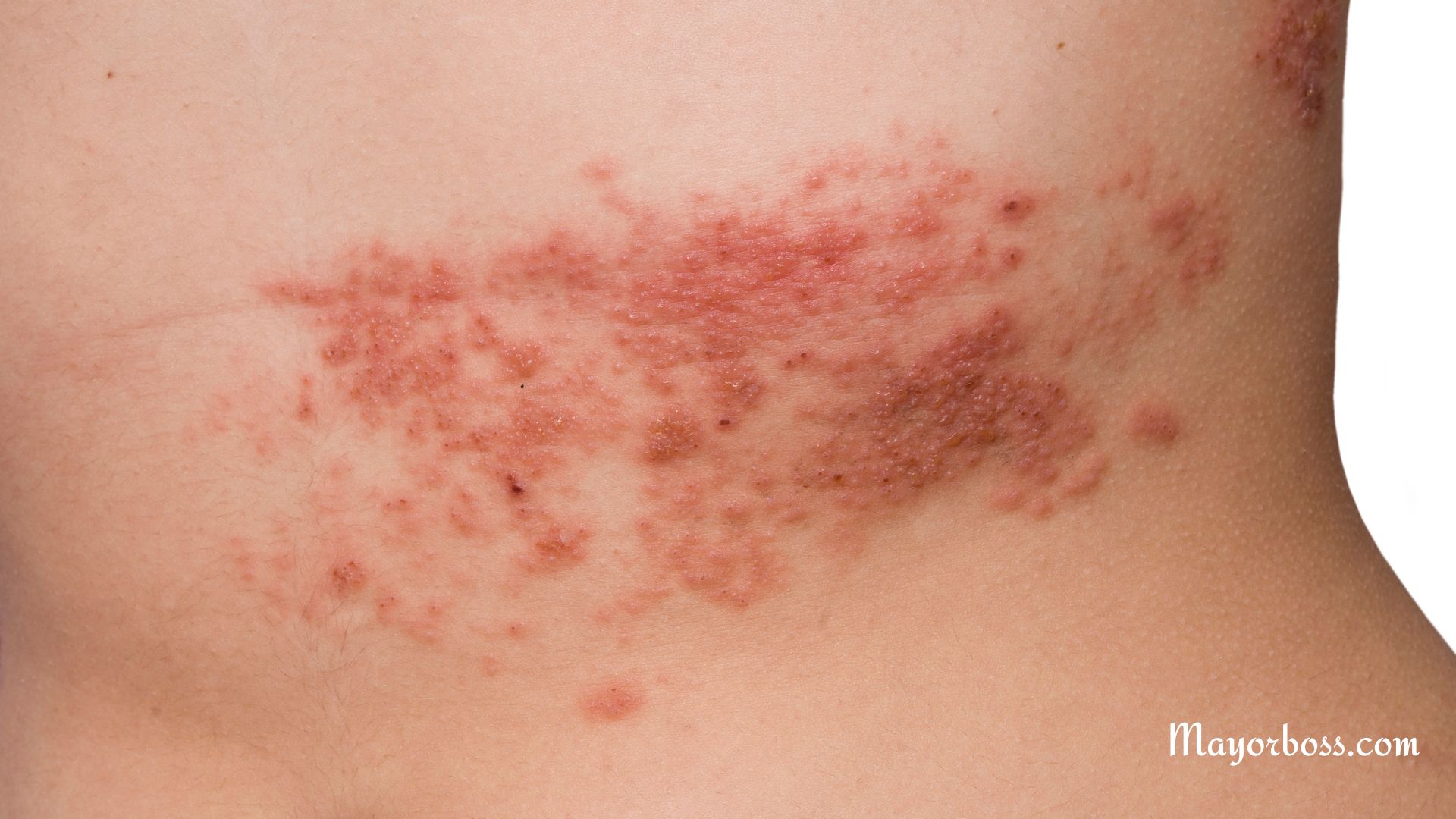 Symptoms of Shingles