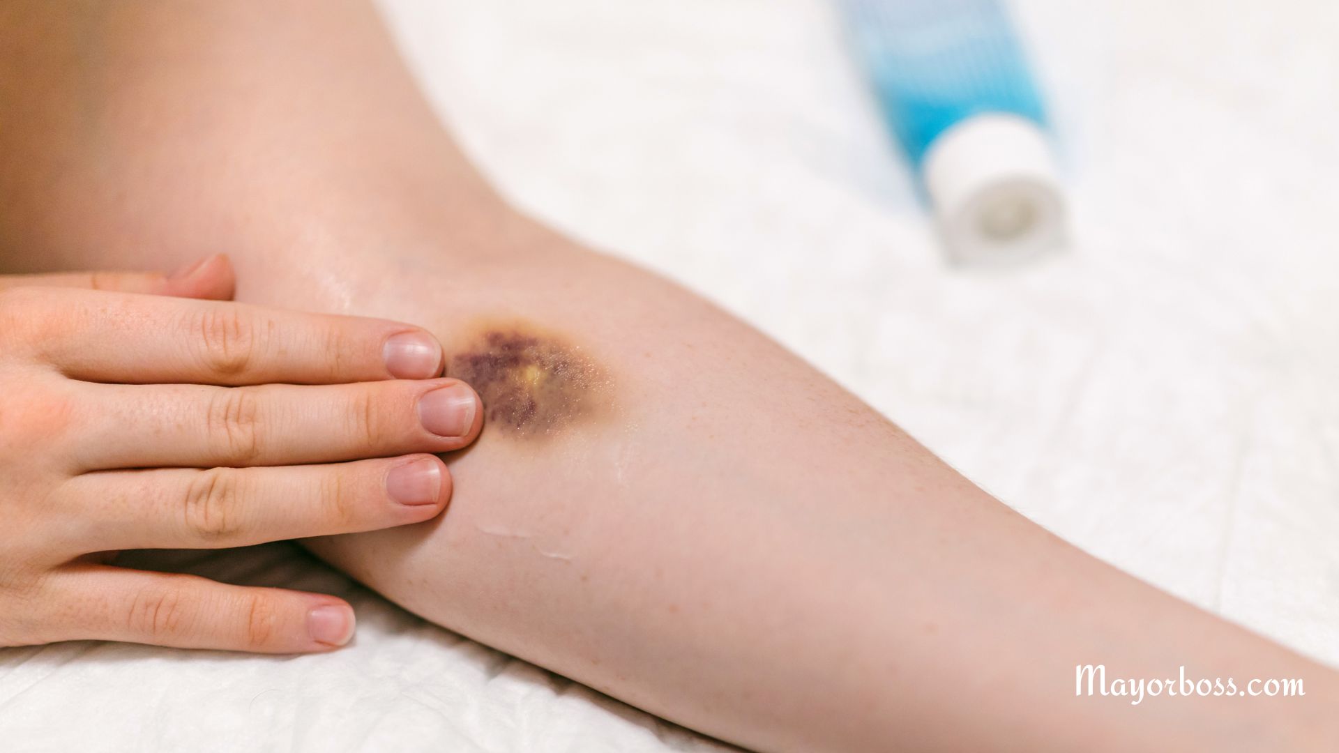 What To Do When A Stubborn Bruise Won’t Go Away