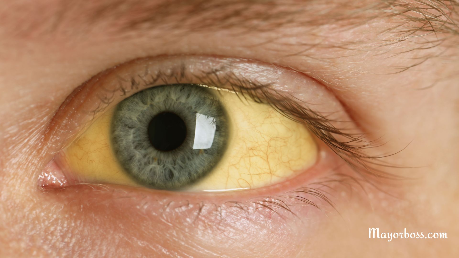 What Causes Yellow Eyes and How to Treat Them