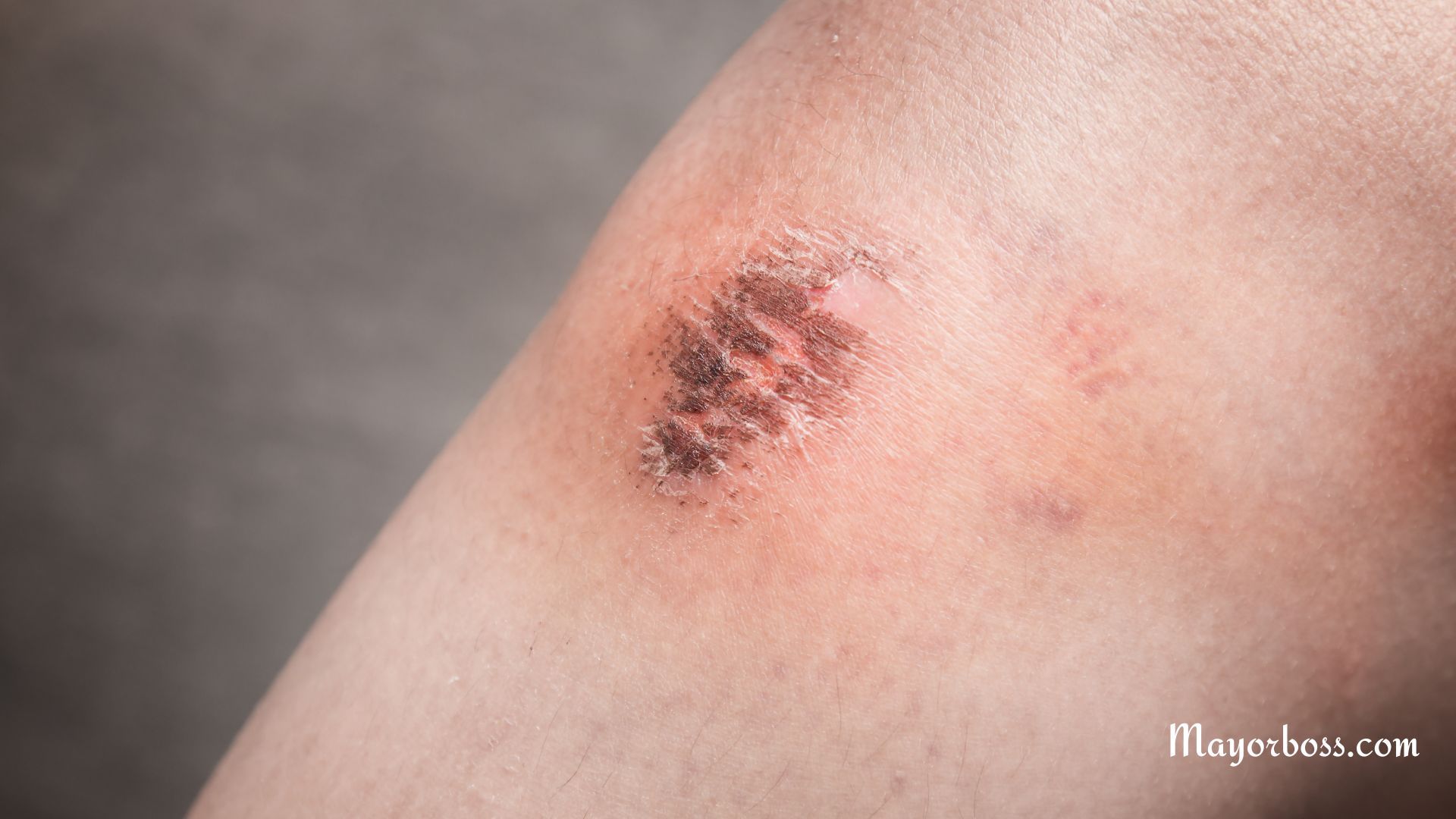 What Causes a White Scab?