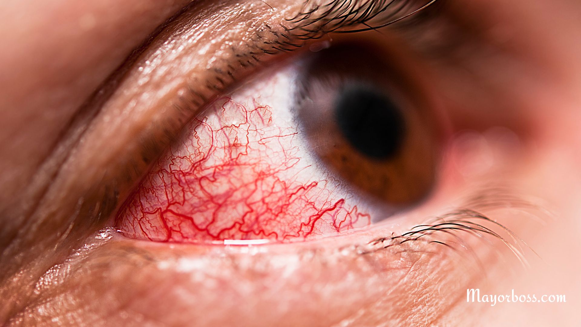 What It Means When You Have Blood in Your Eye