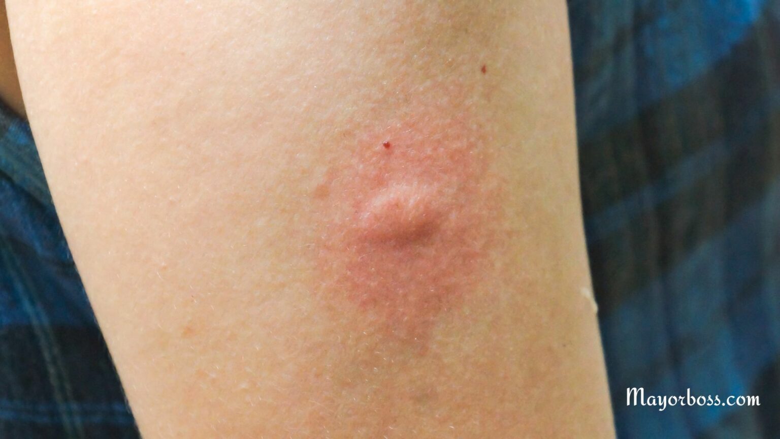 What Kind of Bug Bite Leaves a Bruise?