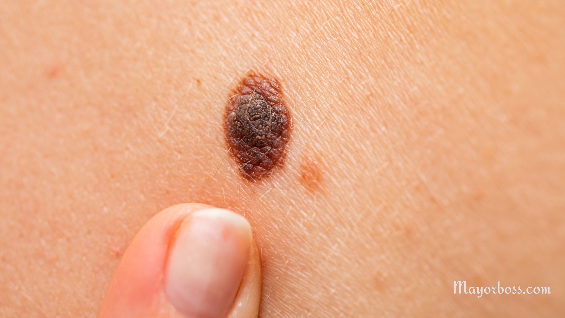 Early Alert: Surprising Warning Signs of Melanoma