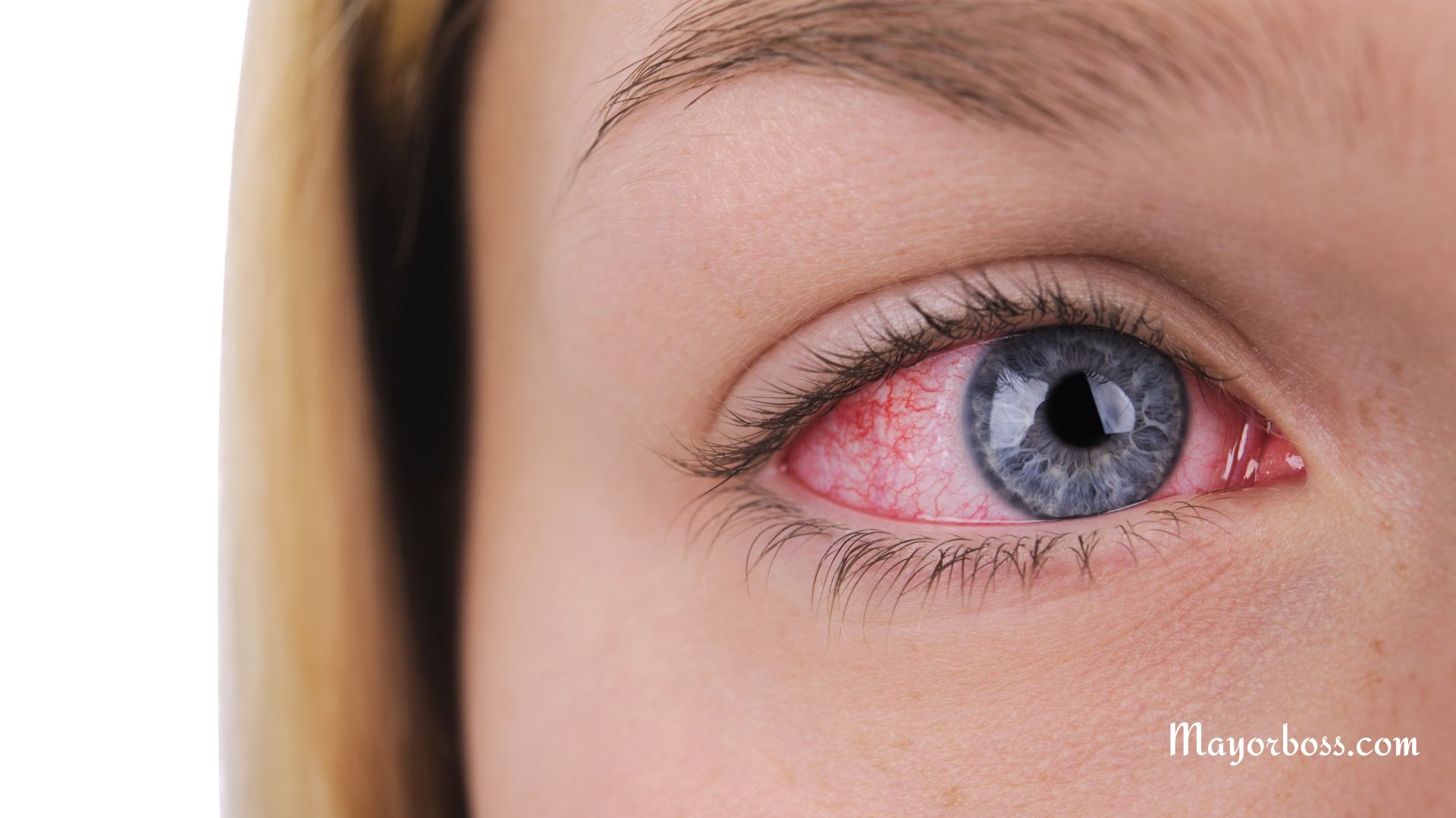 How To Get Rid Of Red Eyes Fast: A Comprehensive Guide