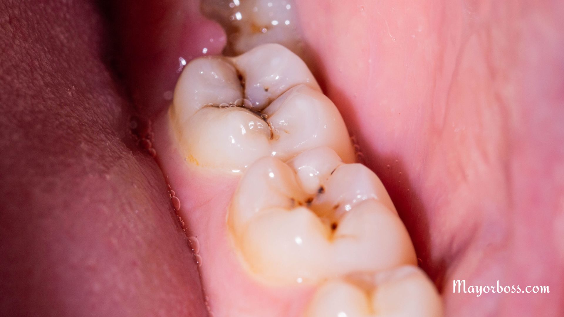 Rinse Your Mouth with This to Stop Cavities from Growing