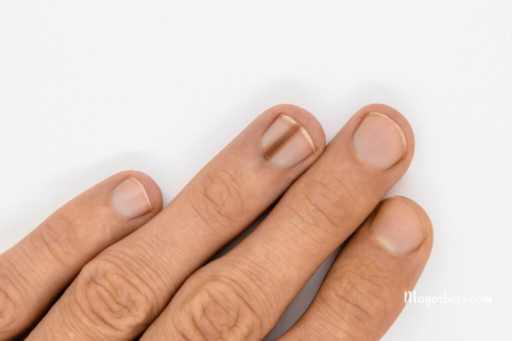 What Causes Black Lines in Nails?