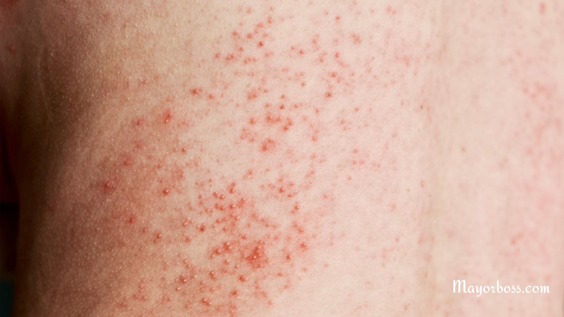 When Hepatitis C Shows Up on Your Skin: Understanding the Rash