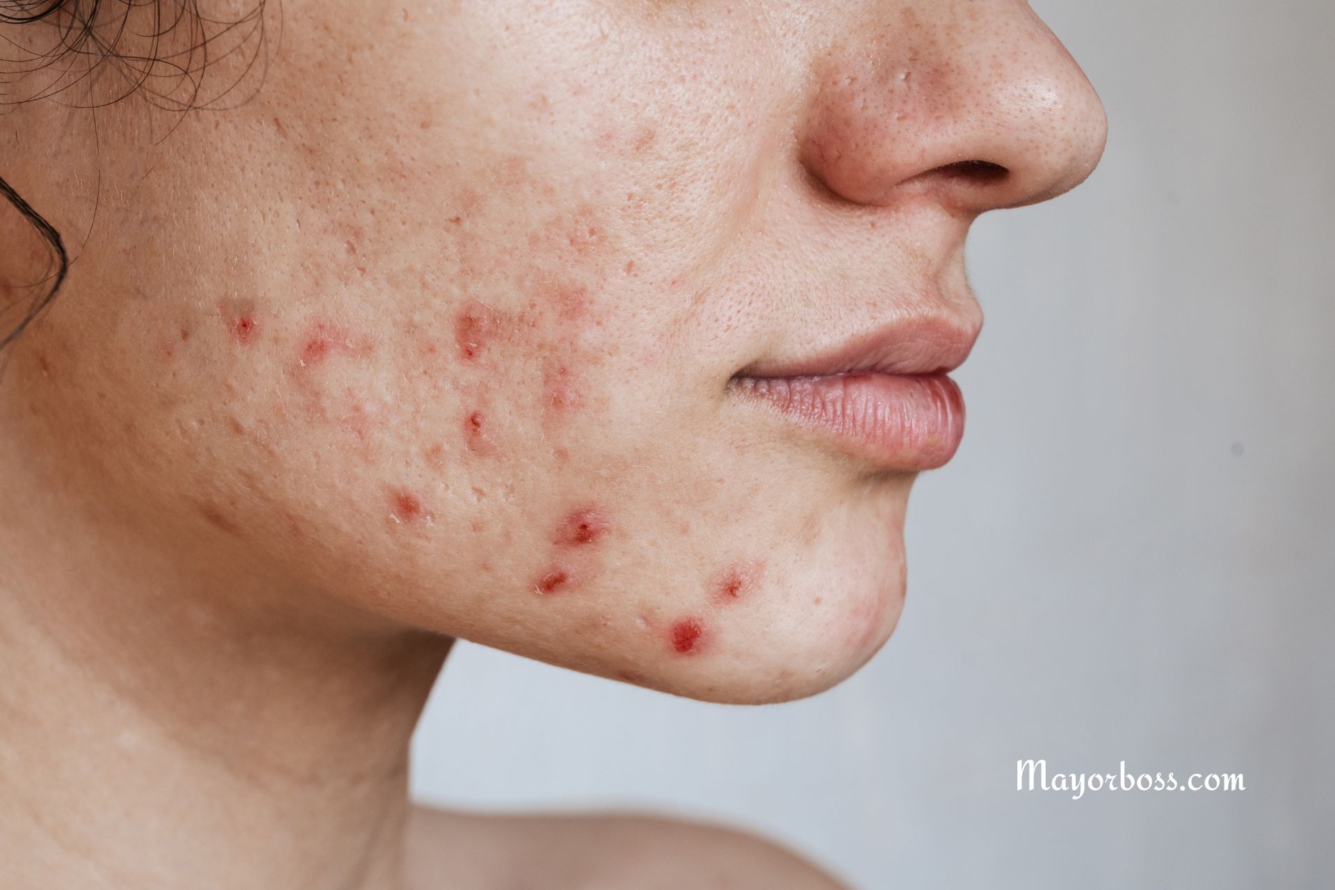 How to Use Benzoyl Peroxide to Treat Acne