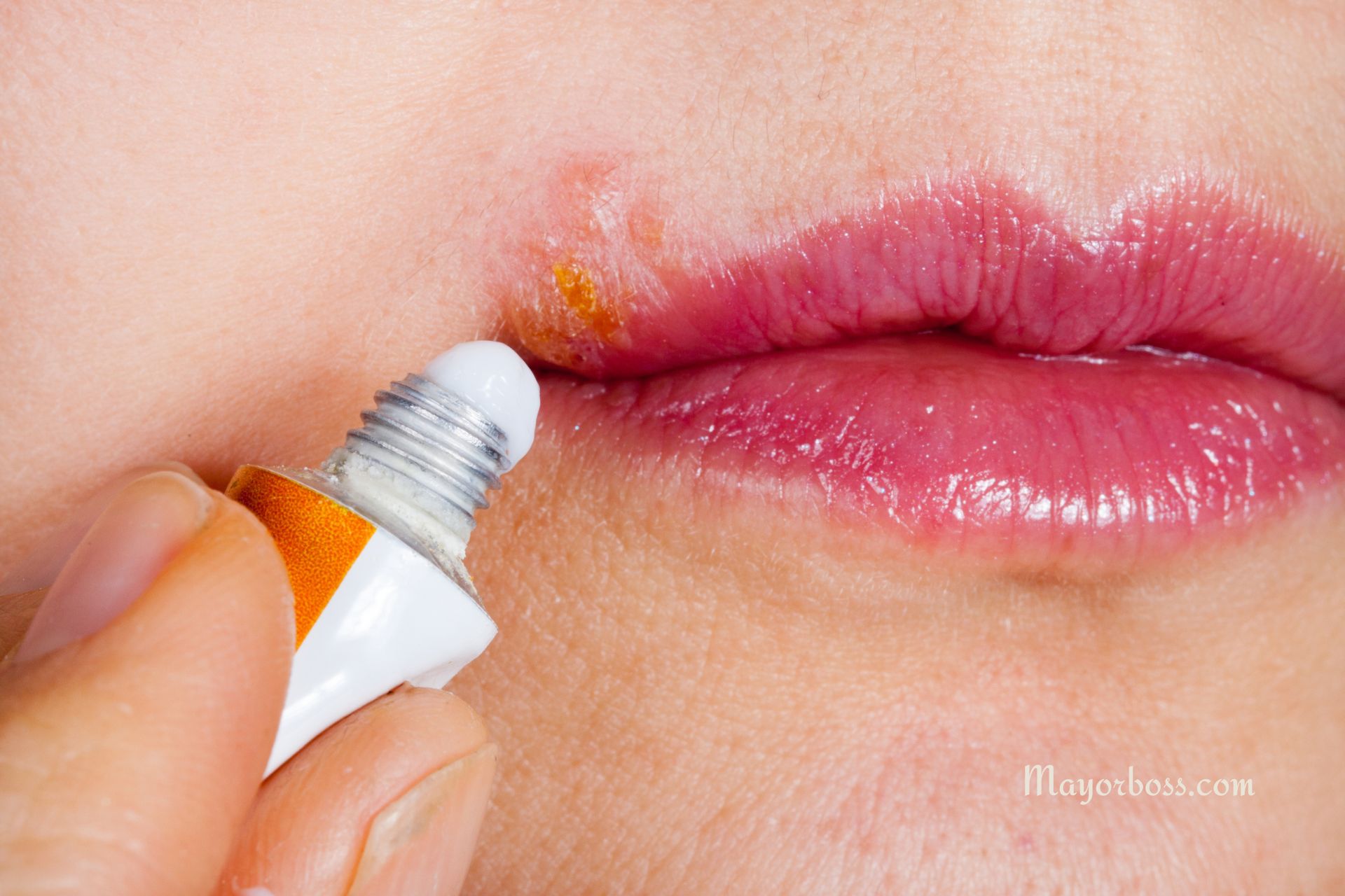 Quick Relief for Cold Sores: Home Remedies and Medications