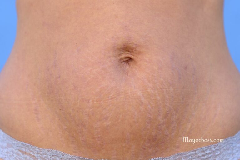 Red Lines on Your Stomach: What They Could Mean and When to See a Doctor