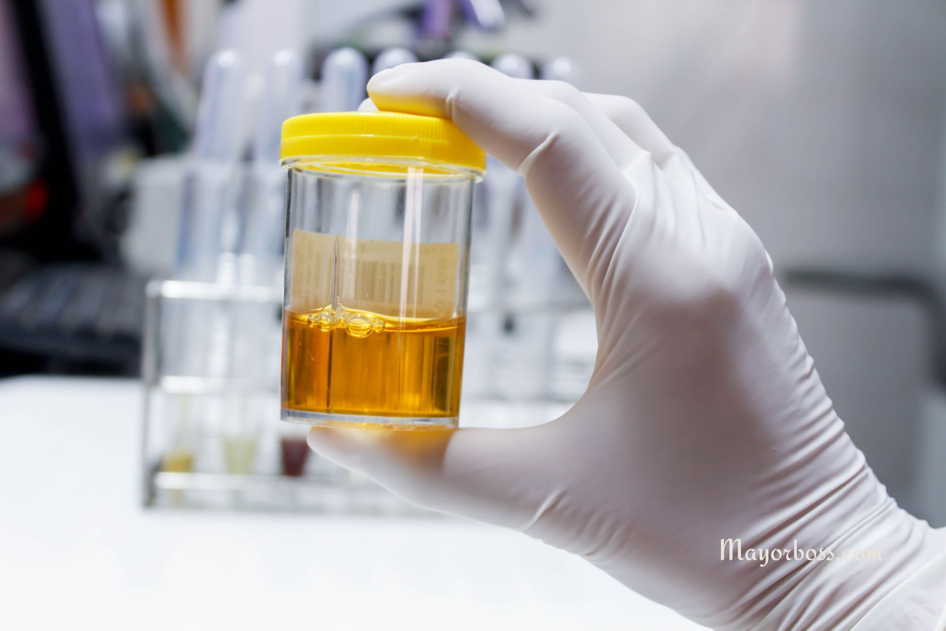 Squamous Cells in Your Urine? What You Need to Know