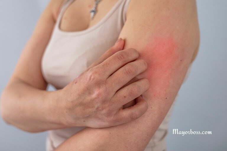 Understanding Sunburn Itching: Causes and Relief