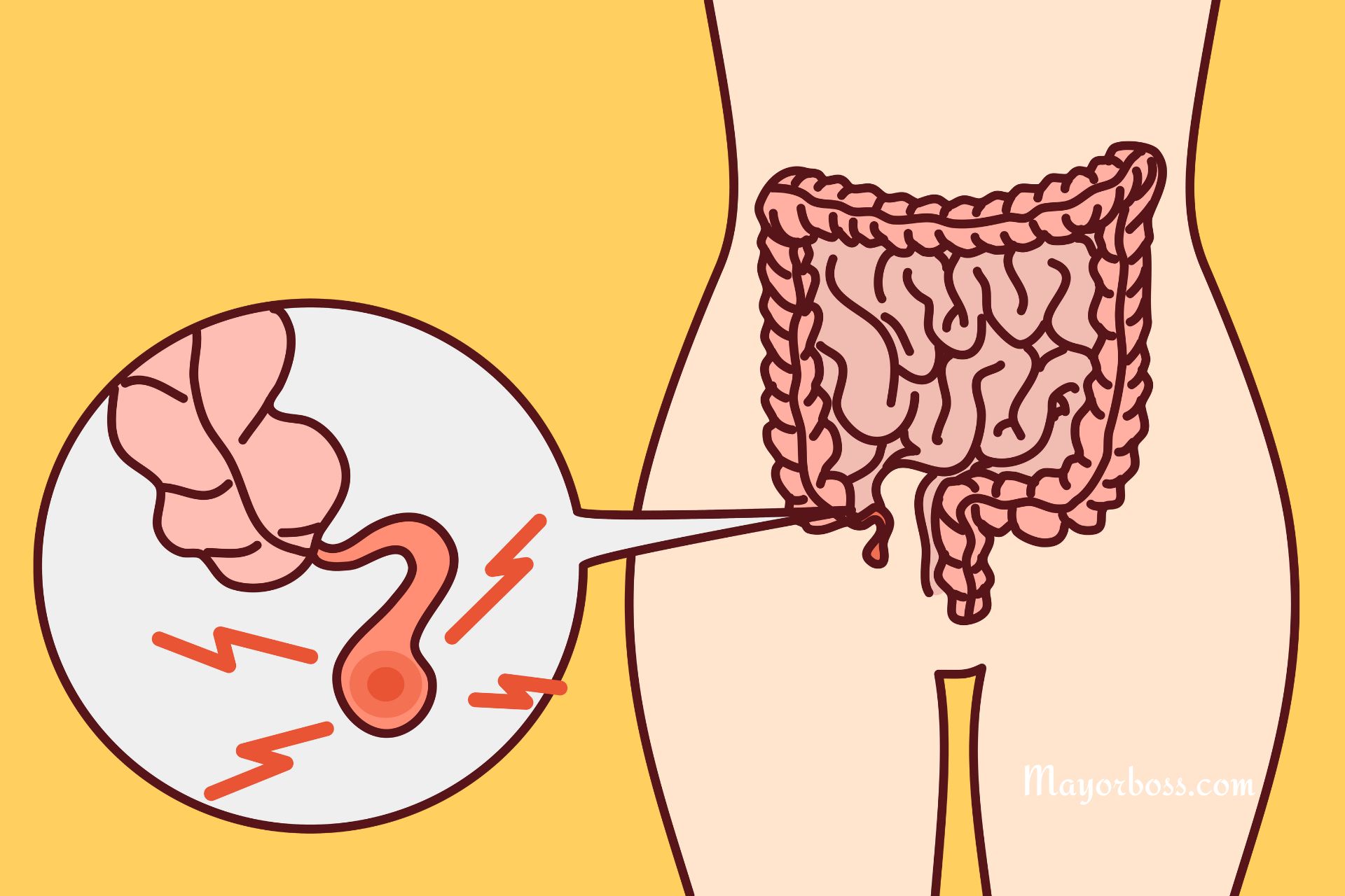 What Side Is Your Appendix On? Understanding Appendicitis