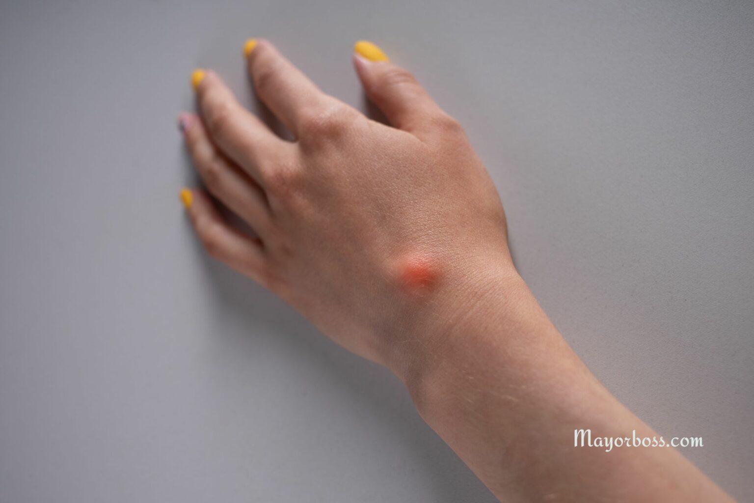 Cysts vs. Boils vs. Abscesses Know the Difference