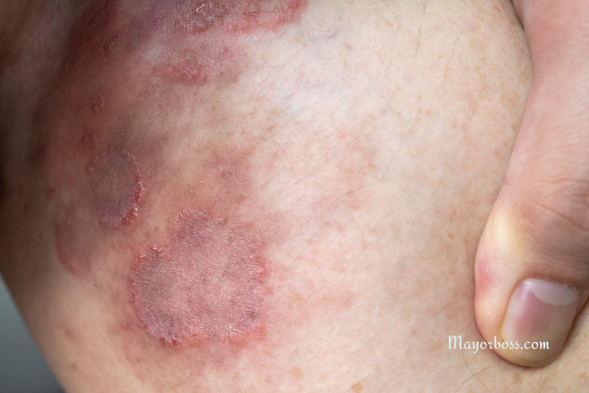 Does Chlorine Kill Ringworm? Get the Facts Here