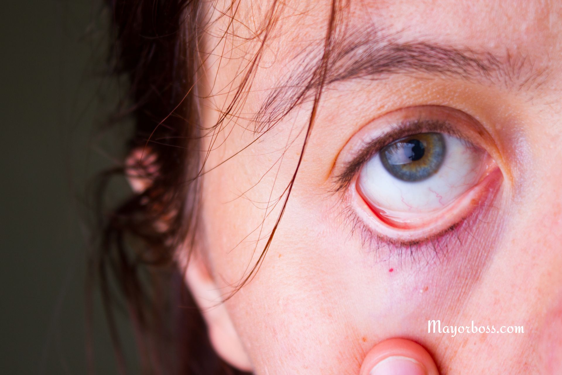 Pale Eyelids? It Could Be Anemia. Here’s What to Know