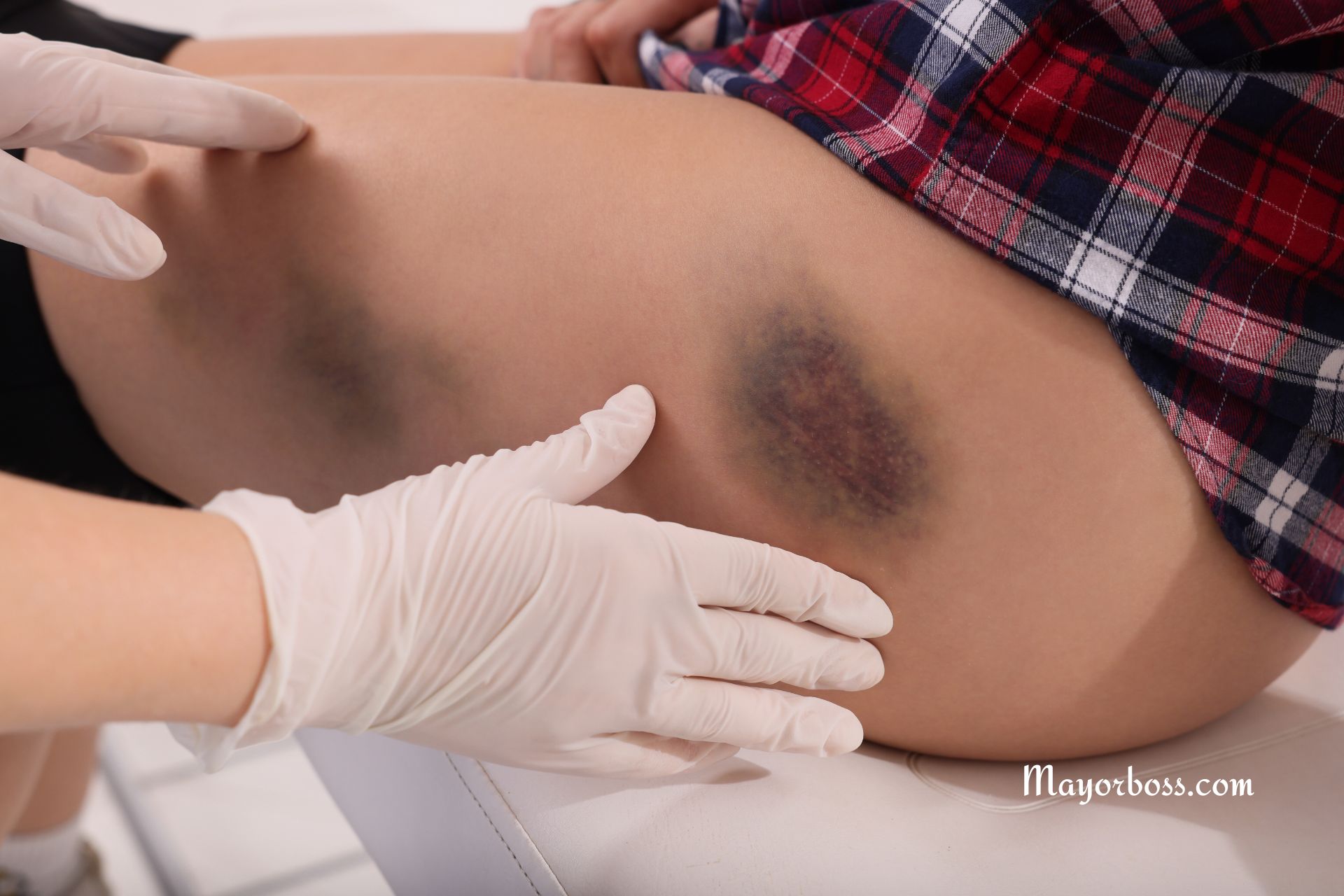 5 Reasons You Bruise Easily (And When to See a Doctor)