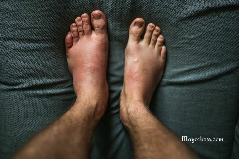 7 Alarming Warning Signs of Swollen Feet You Should Never Ignore