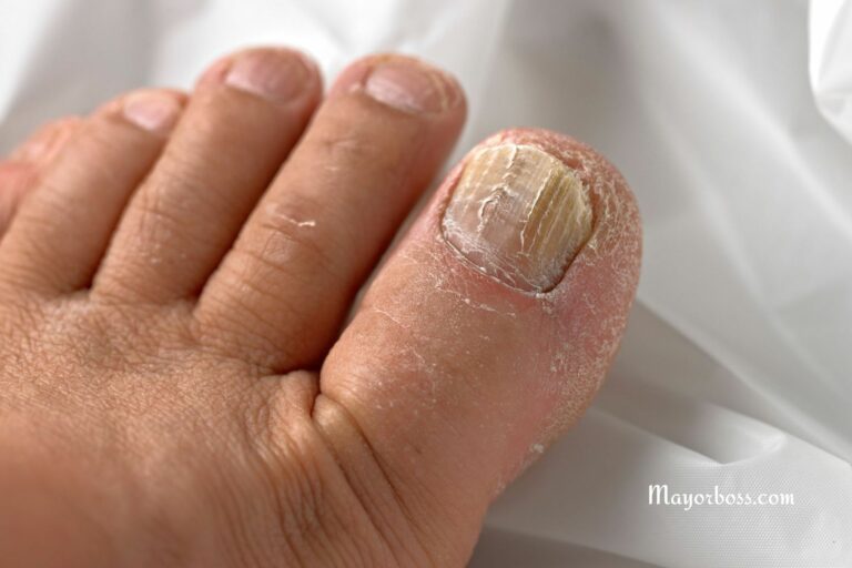 Don’t Ignore Toenail Fungal Infections! Here’s Why It Can Get Serious