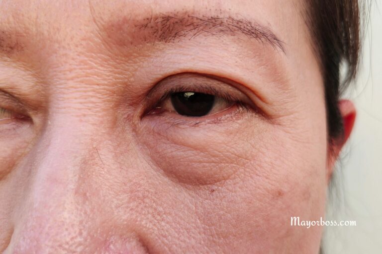 Natural Remedies to Reduce Bags Under Your Eyes