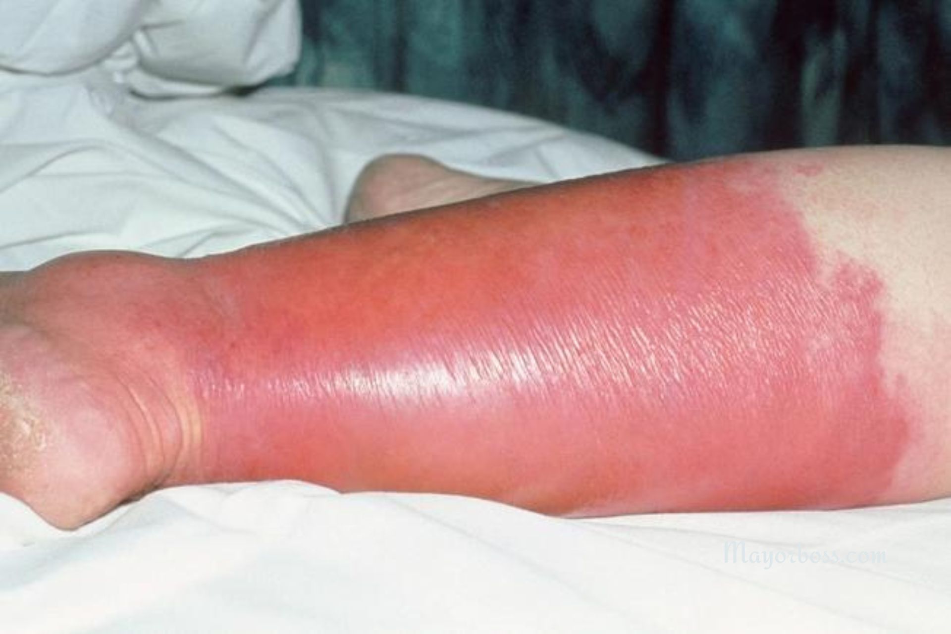 Common Symptoms of Cellulitis