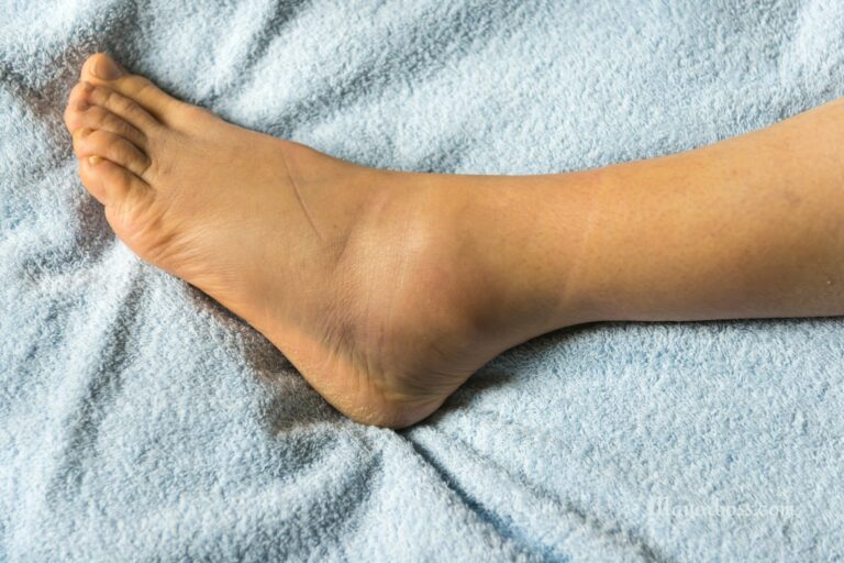 How to Get Rid of Swollen Ankles Fast
