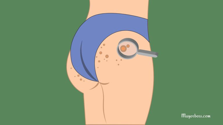 5 Simple Ways to Get Rid of Butt Acne Quickly