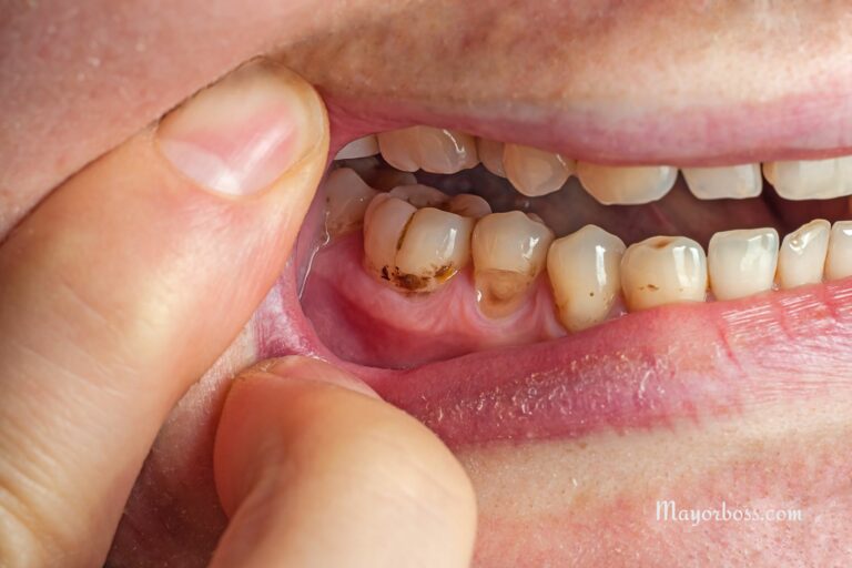 Tooth Decay Could Shorten Your Life: The Hidden Health Risks of Cavities